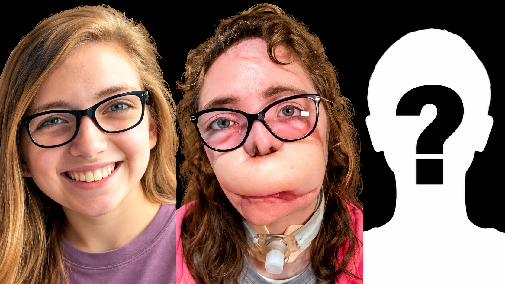 How did she survive a devastating facial injury?