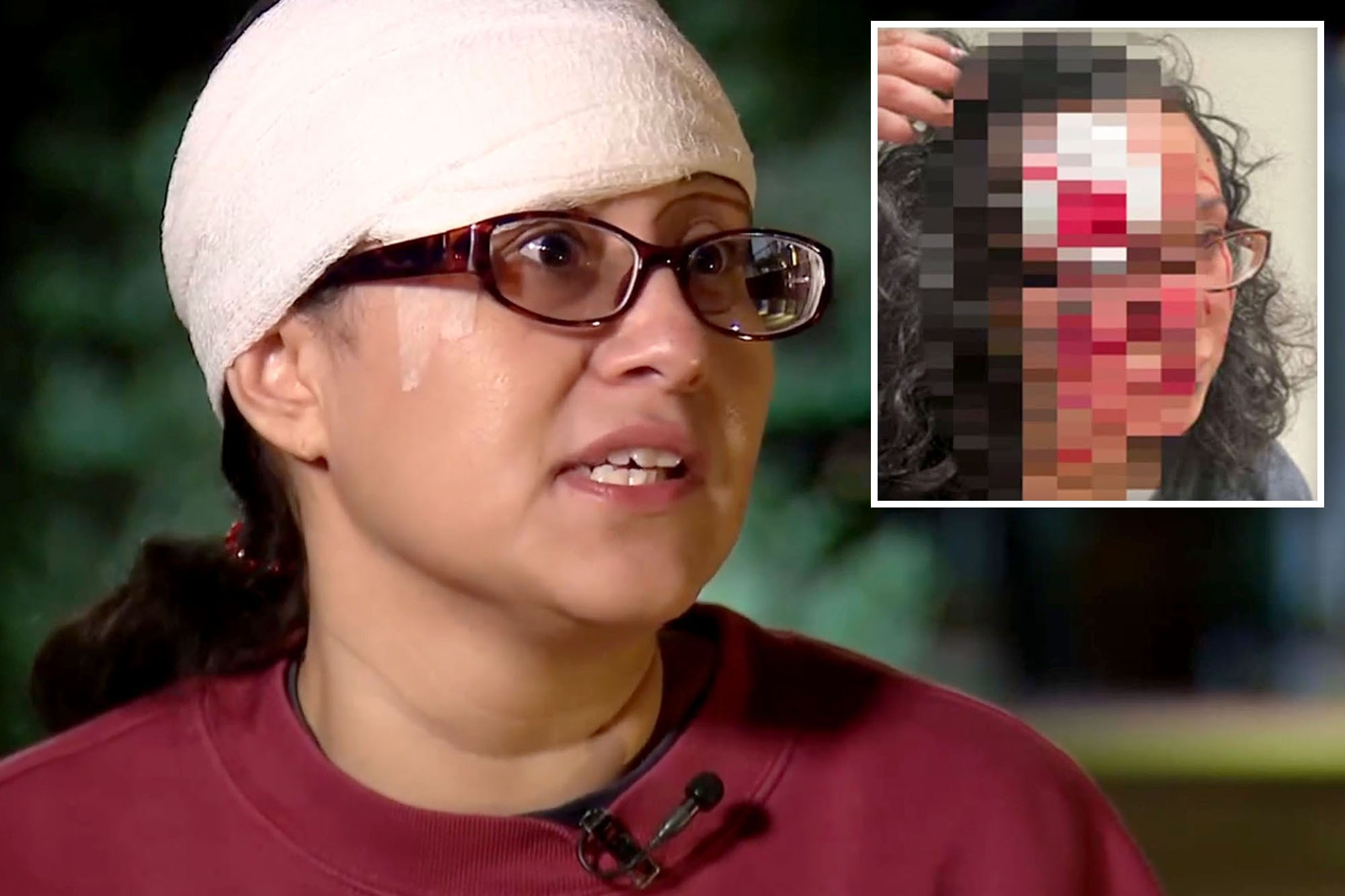 Woman accused of biting chunk out of victim’s forehead in 'zombie bite ...