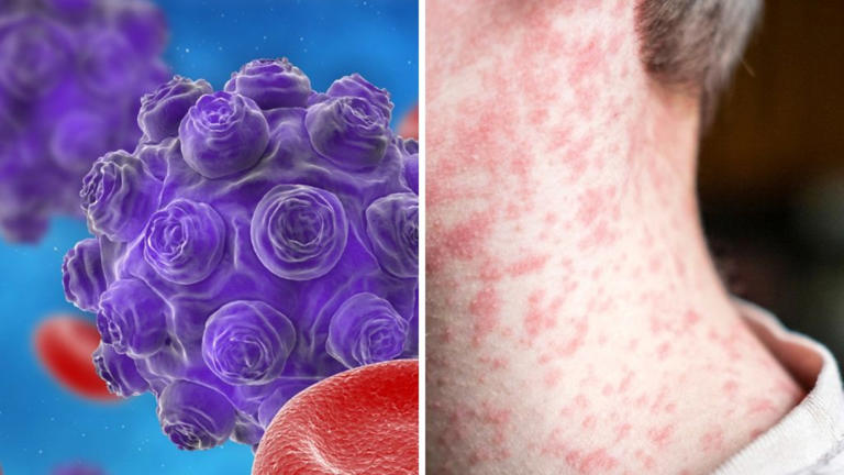 Virus warning as outbreak widens