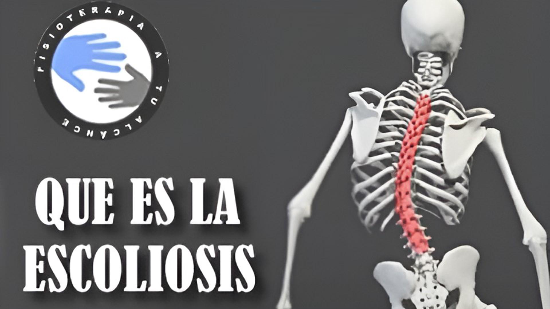 Que es la escoliosis de columna
