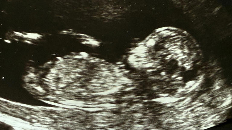 ASX debutant aims to revolutionise prenatal screening