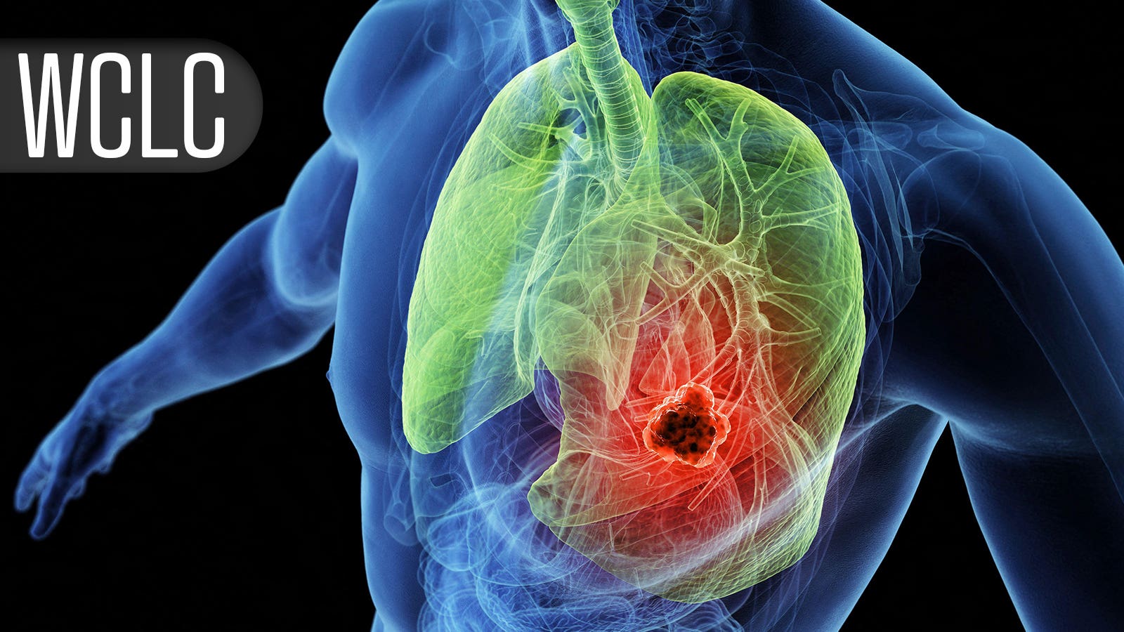 No survival bump in metastatic NSCLC with addition of ADC to immunotherapy