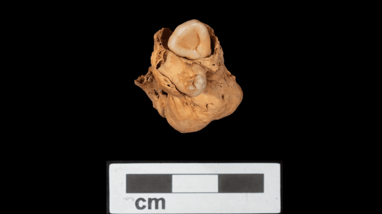 Creepy 3000-year-old tumour with teeth found in ancient burial site