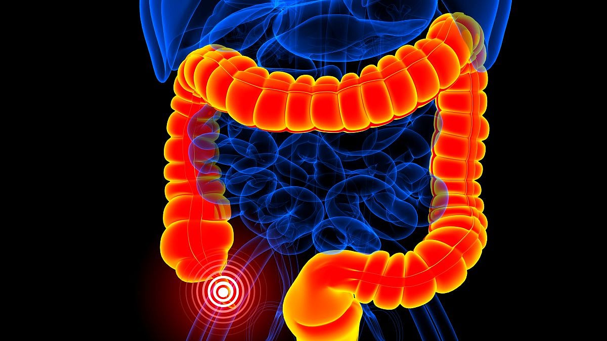 ACS: Risk for subsequent CRC reduced with appendectomy