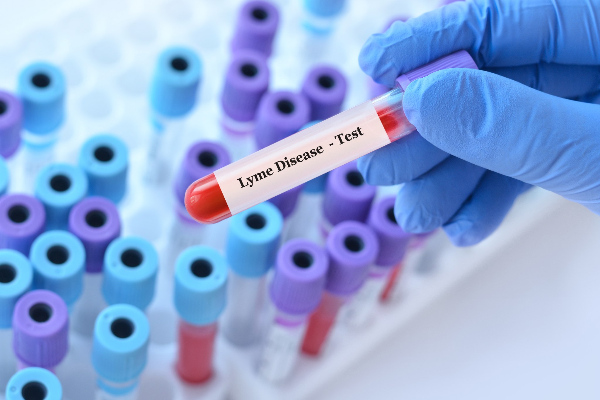 For 28 years, a woman blamed aging for her symptoms. Then came a Lyme diagnosis