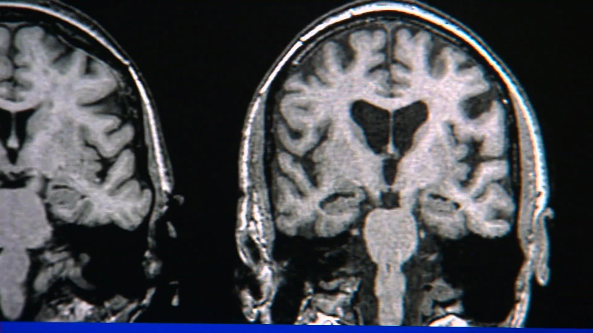 Officials estimate millions live with a brain aneurysm, but what are ...