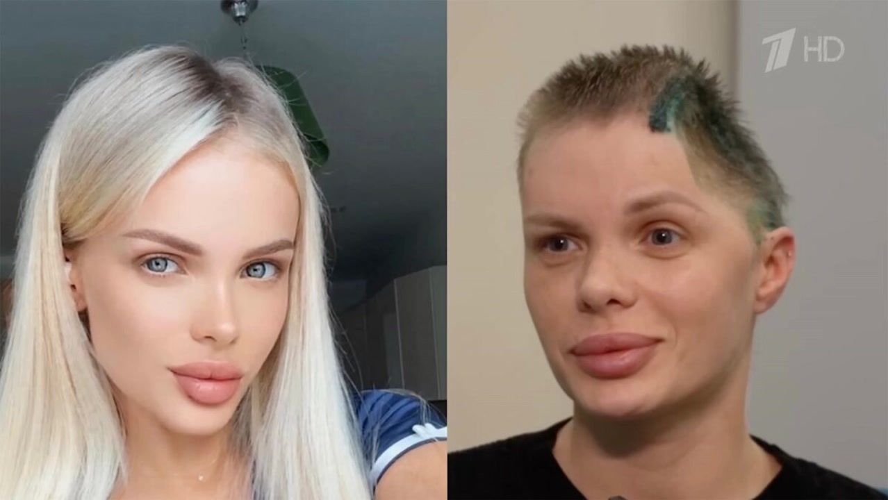 Top model left with half her skull after millionaire boyfriend did the ...