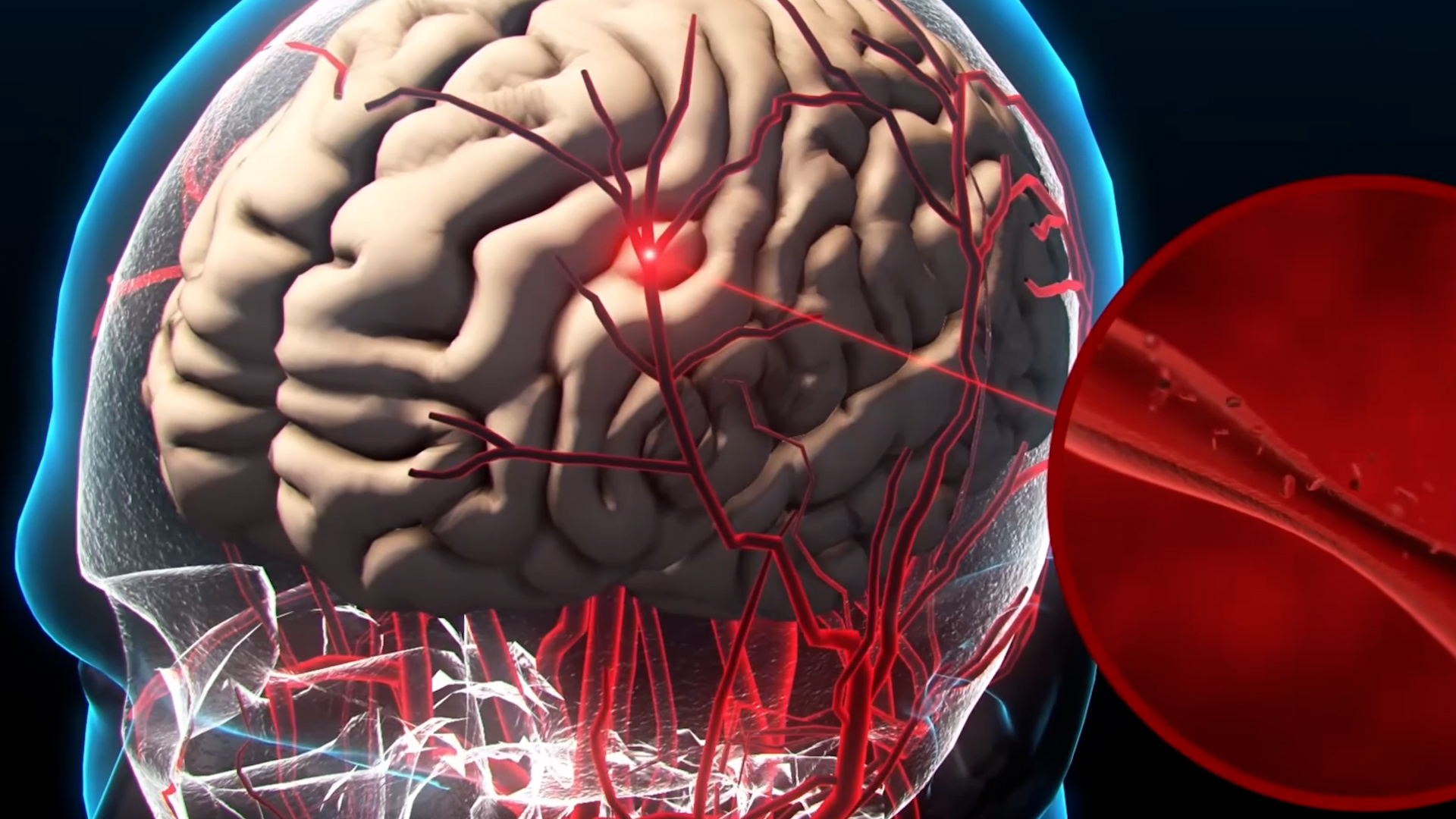 A neurologist explains the stroke warning signs that need an emergency ...
