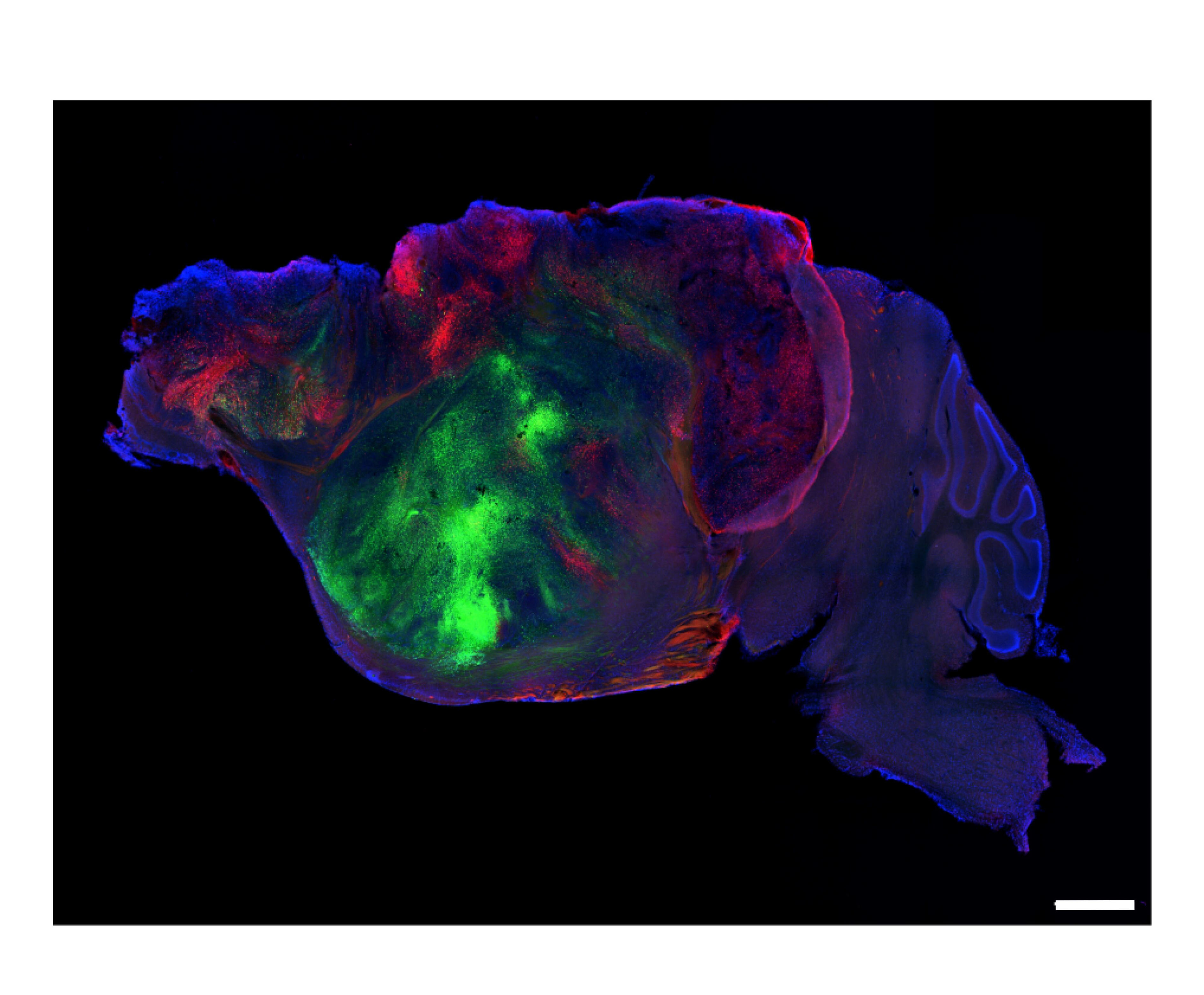 Human mini-brains fill most of mouse cerebral cortex