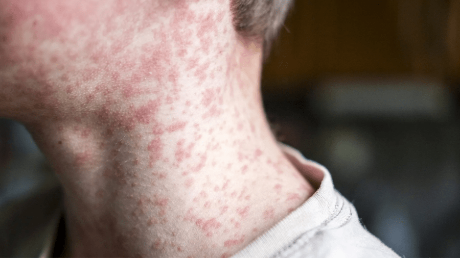 New measles case confirmed in northeast Kansas