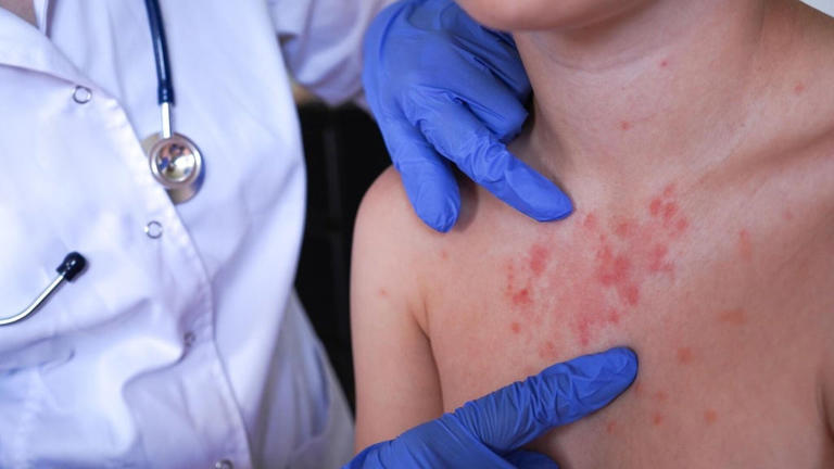 DuPage County reports first measles case of 2026, with exposure at ...