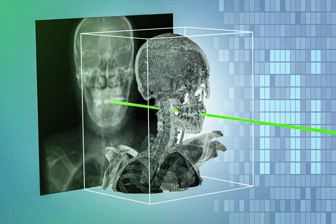 Patient-specific AI technique could make minimally invasive surgeries ...