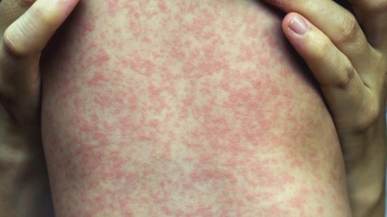 Maine CDC warns of measles exposure at Waterville urgent care