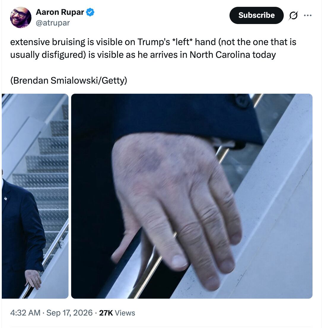 Trump’s gnarly bruised hand makes shocking reappearance