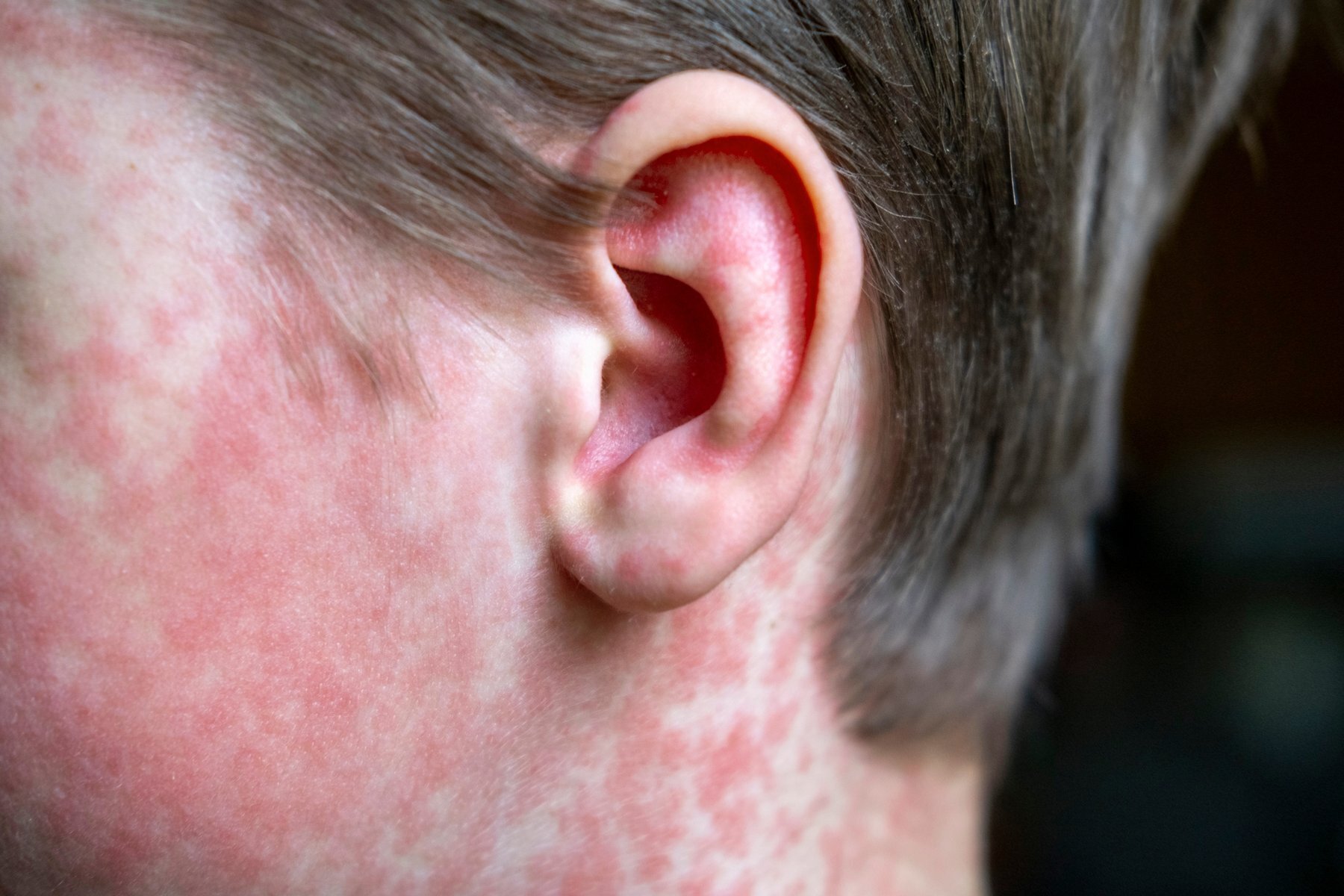 10 facts to know about measles
