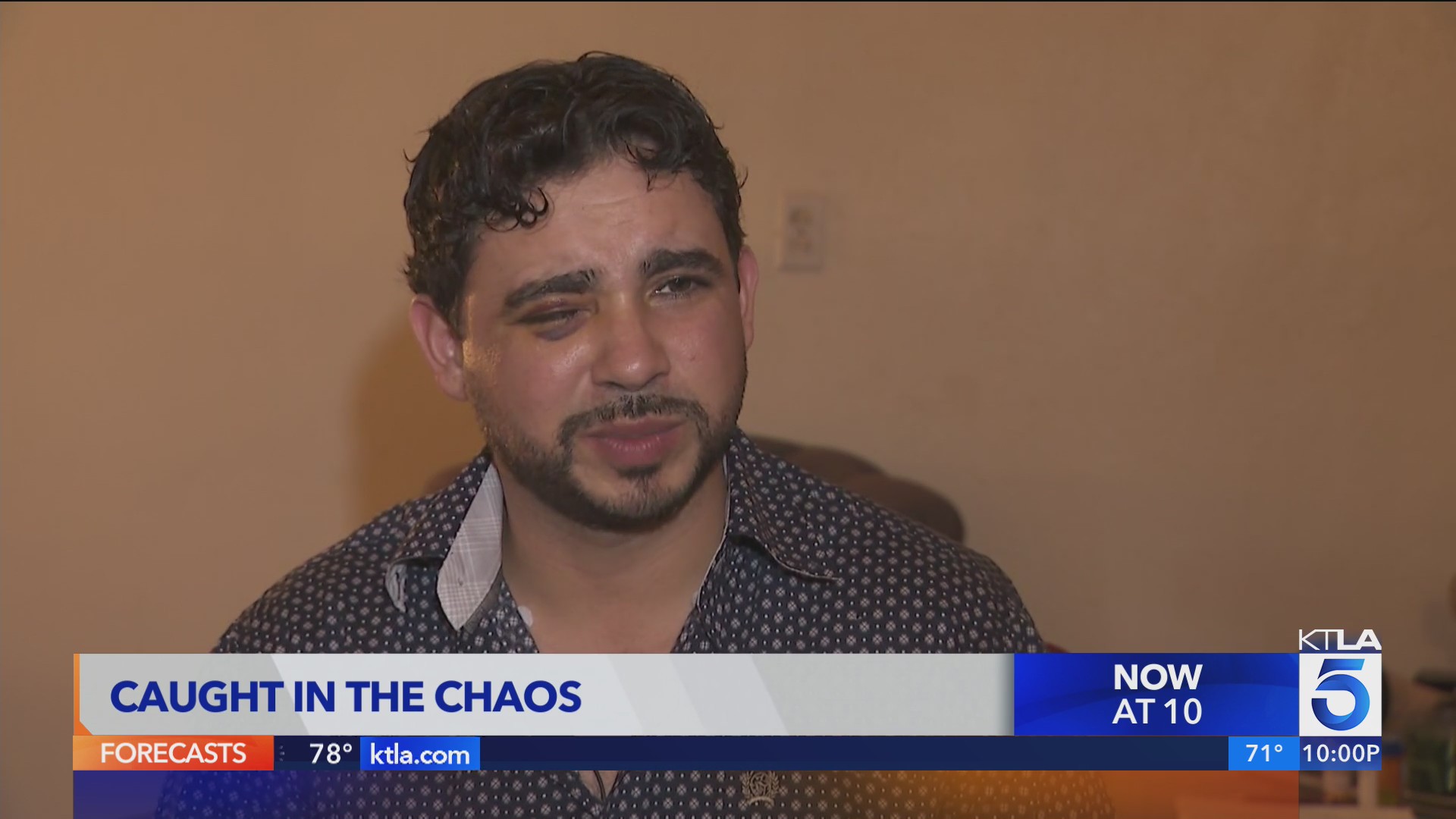 Man left with bullet in eye after shooting incident in LA