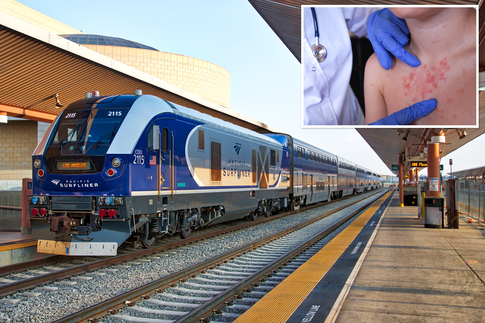 Unvaccinated measles traveler on Amtrak sparks warnings across California