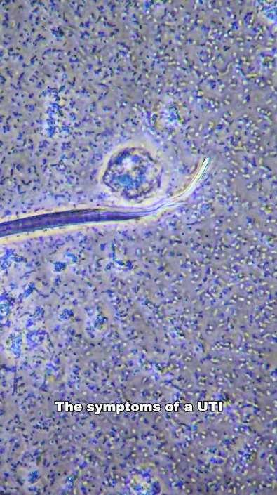 What a UTI actually looks like up close