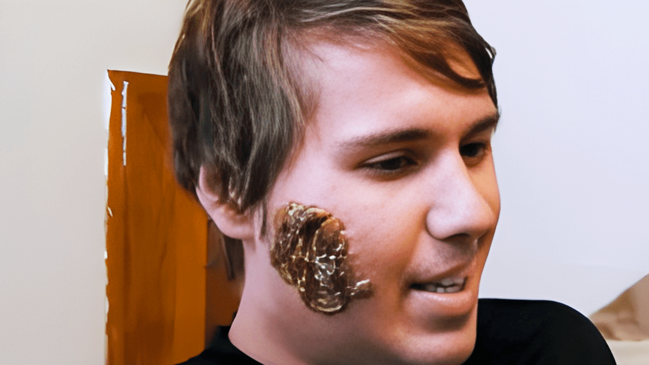 What happens when parasites invade facial tissue?