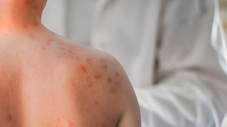 Scarlet fever or something else? Re-examining the medical case of Mary ...