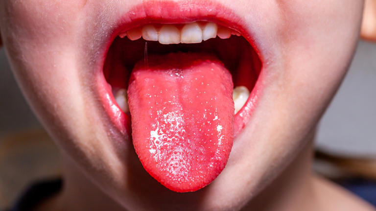 Scarlet fever or something else? Re-examining the medical case of Mary ...