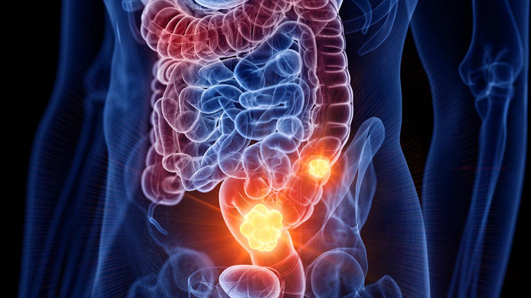 Oncologist who cut open people for 17 years saw same foods in 80% of ...