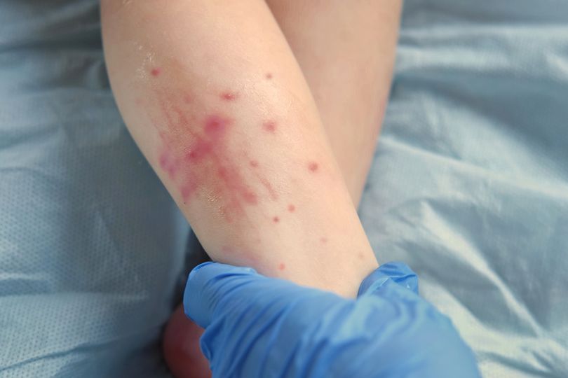 HSE issues warning about scarlet fever and shares important symptoms
