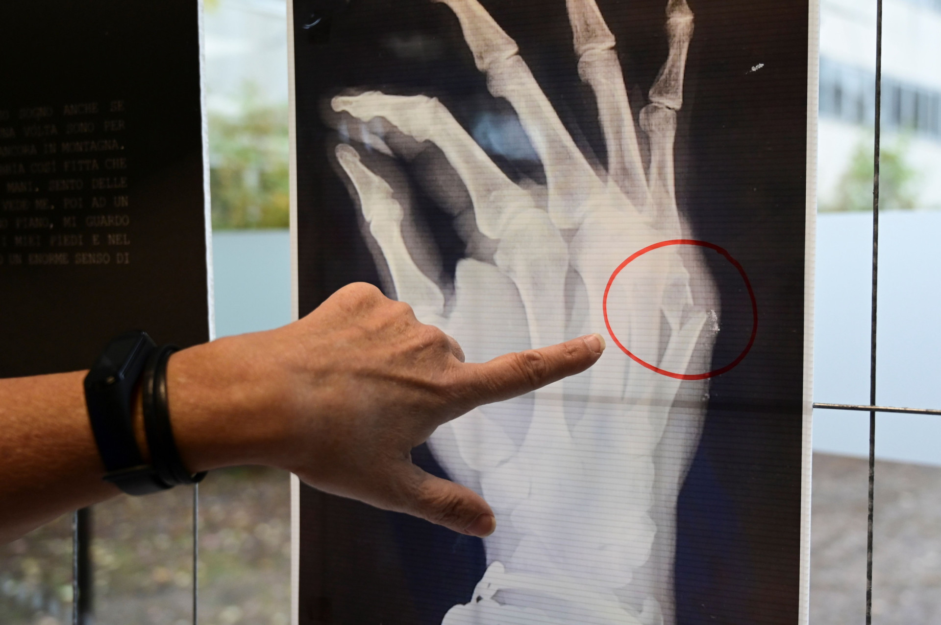 The most commonly broken bones in the body