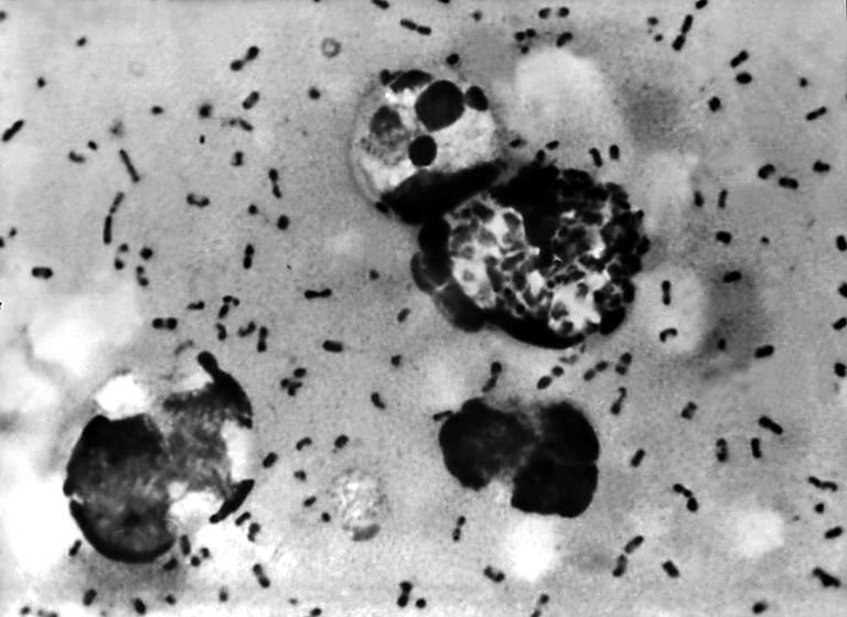 Pneumonic plague symptoms explained after Russian scientist's death
