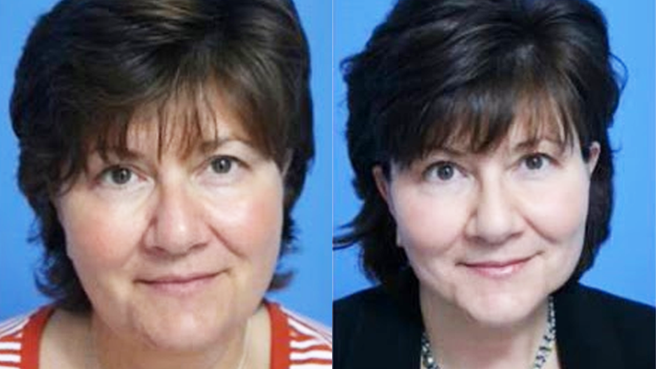 What can you do about puffy cheeks?