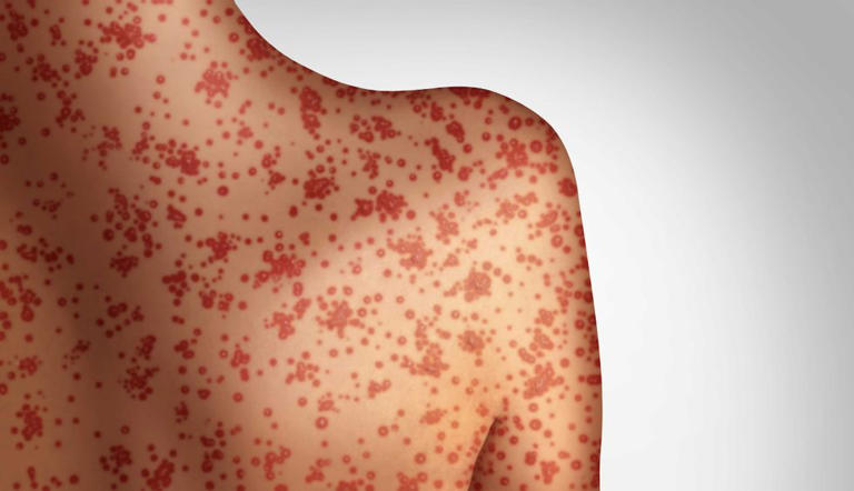 Hochul declares emergency in measles outbreak