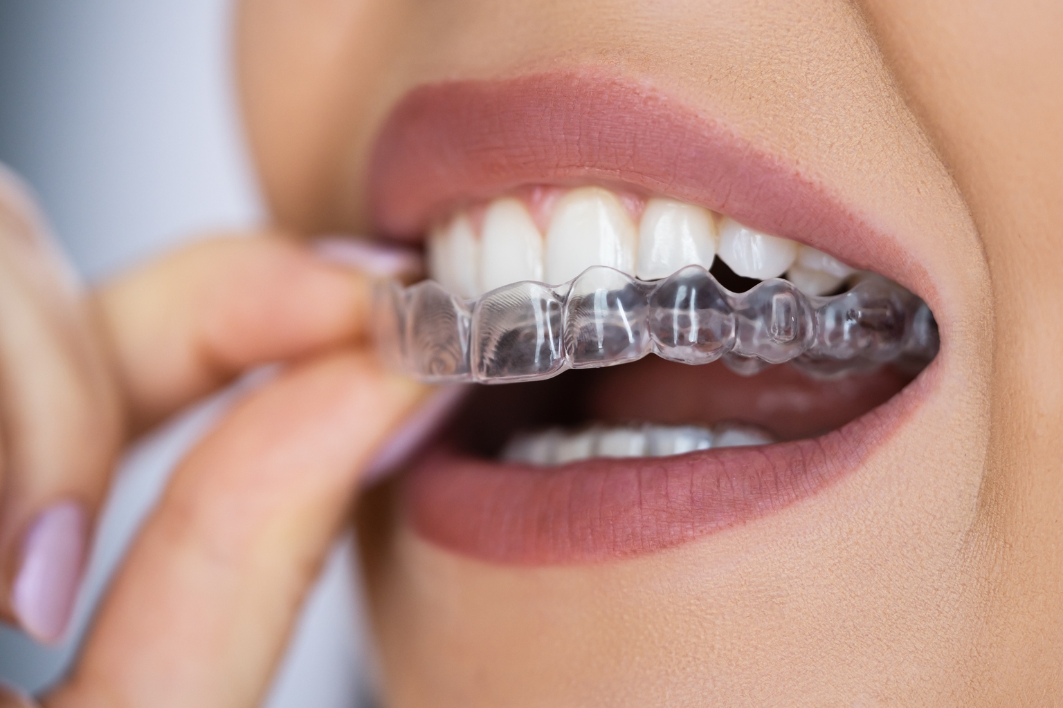 Align Technology says European court finds Angelalign infringed patent