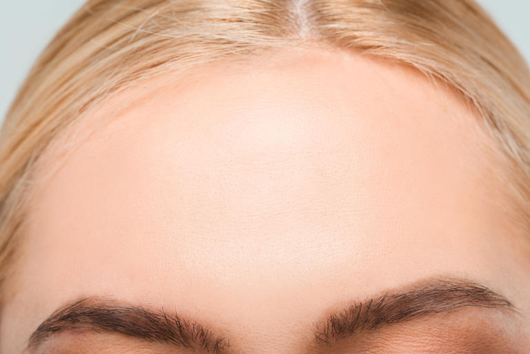 Forehead reduction surgery in Turkey: What patients should know