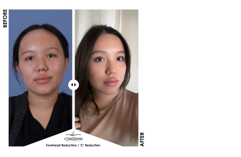 Forehead reduction surgery in Turkey: What patients should know