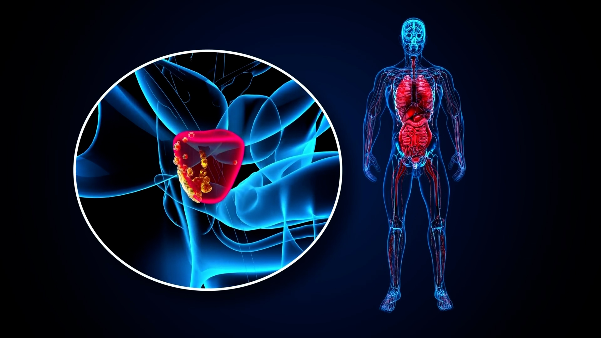A urologist explains what a prostate biopsy involves and who really ...
