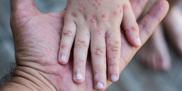 A fifth person has died in Pennsylvania’s measles outbreak as US hit a ...
