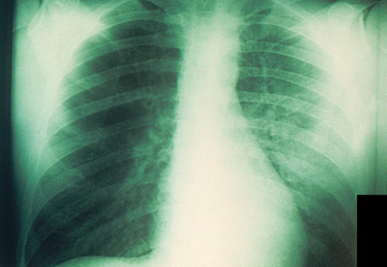 Pneumonic plague highly unlikely to reach US, ex-CDC director says
