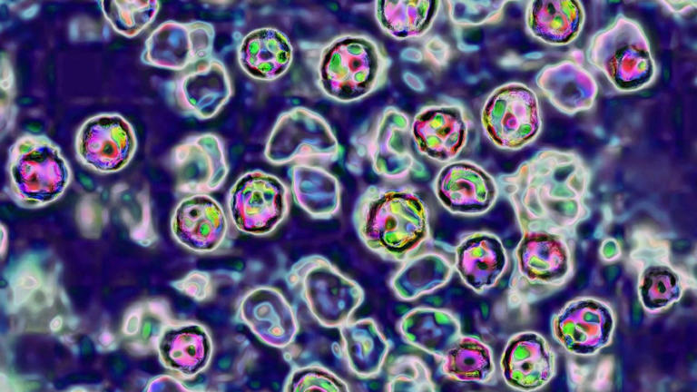 Measles in Wisconsin: 10 confirmed cases in Chippewa County