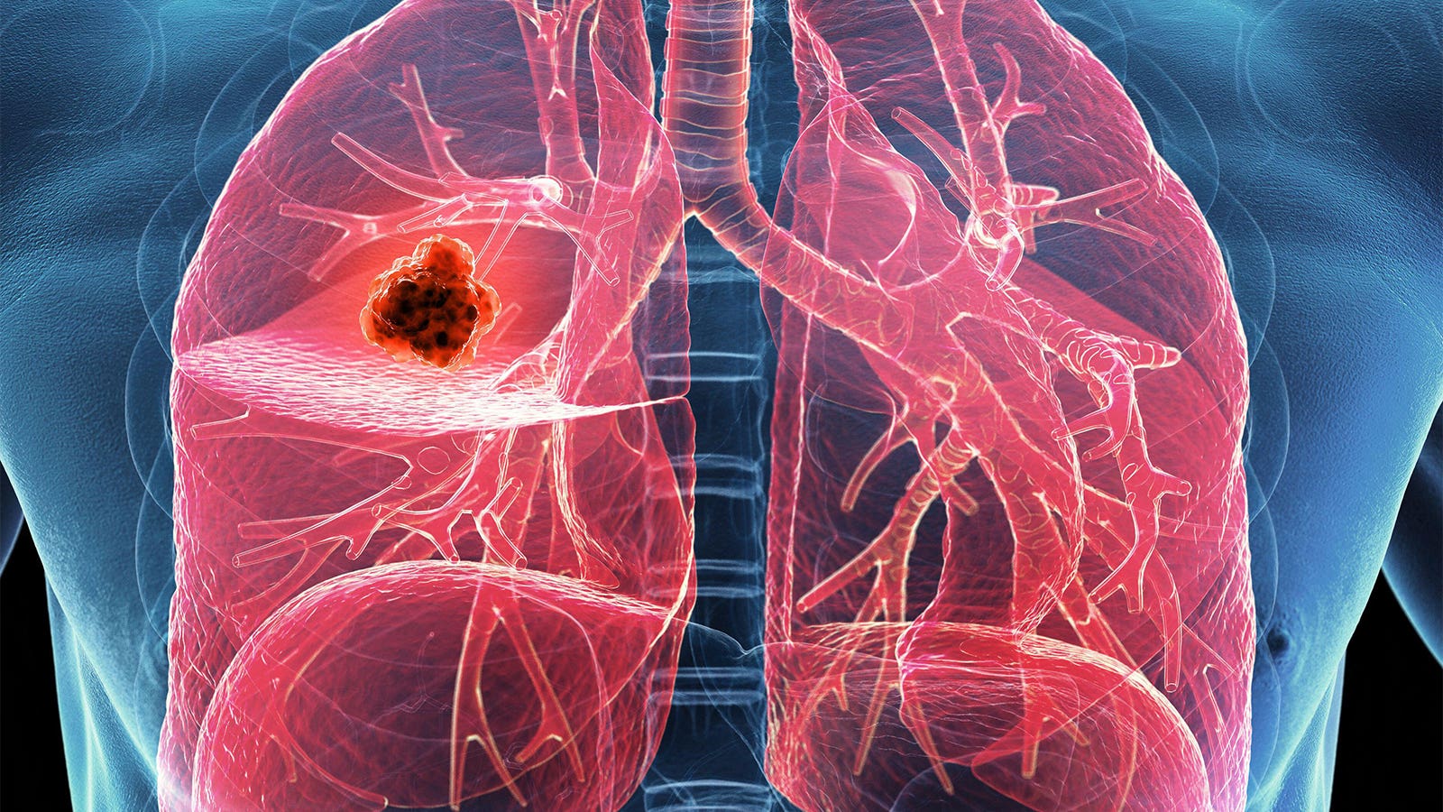 Chemo-free regimen may be effective option for EGFR-mutant lung cancer