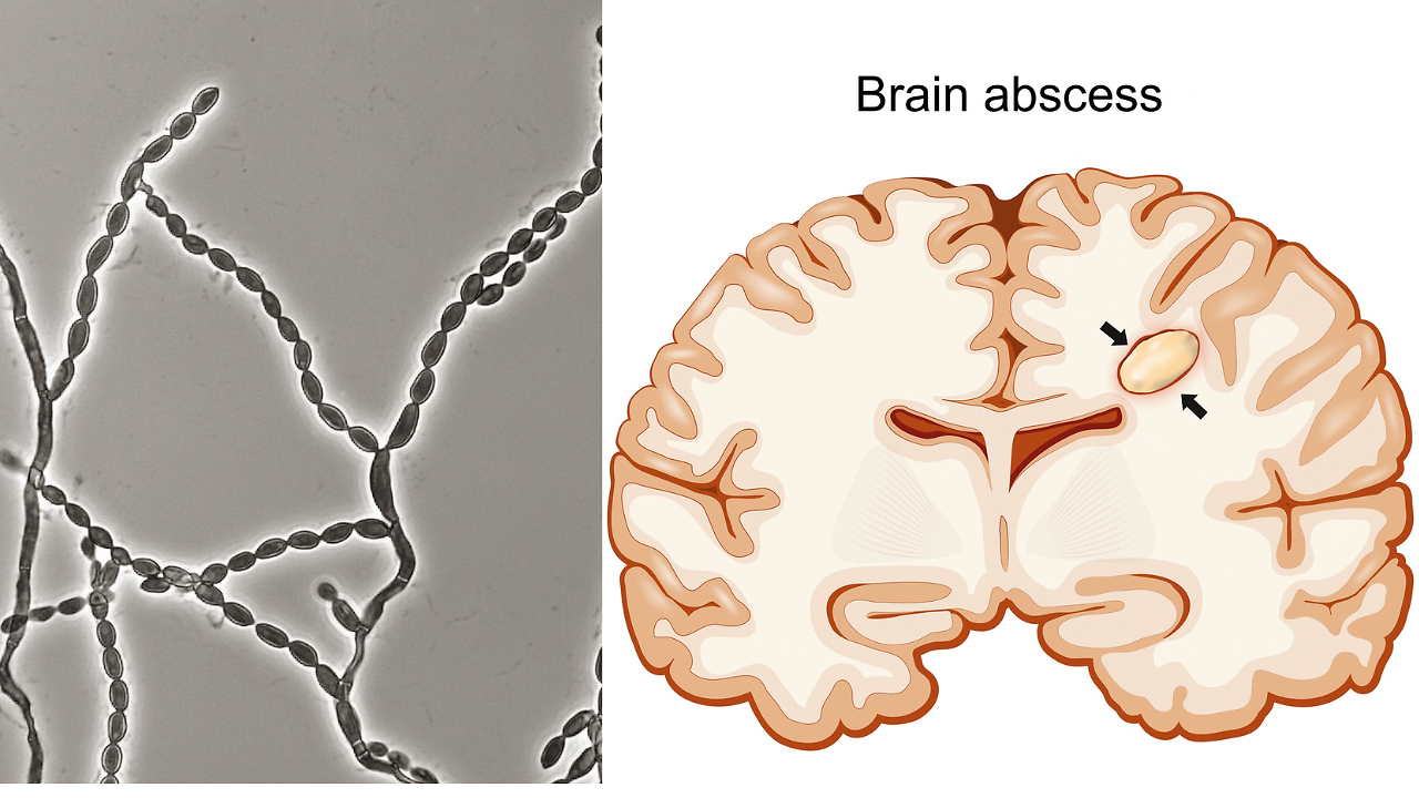 Cladophialophora bantiana: US CDC flags surge in deadly brain fungus cases