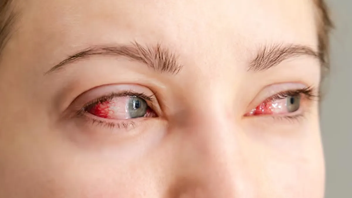 Eyes red after swimming or showering? Doctors explain what’s irritating ...