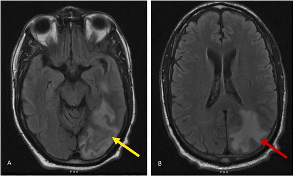 A deadly fungus that attacks the brain with a 70% fatality rate is ...