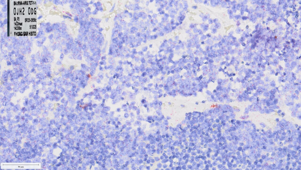 Key driver of aggressive prostate cancer identified, suggesting new way ...