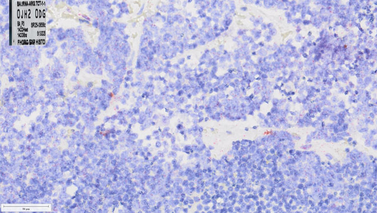 Key driver of aggressive prostate cancer identified, suggesting new way ...
