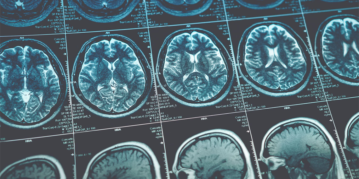 Brain scans reveal opposite reward responses in ADHD and autism