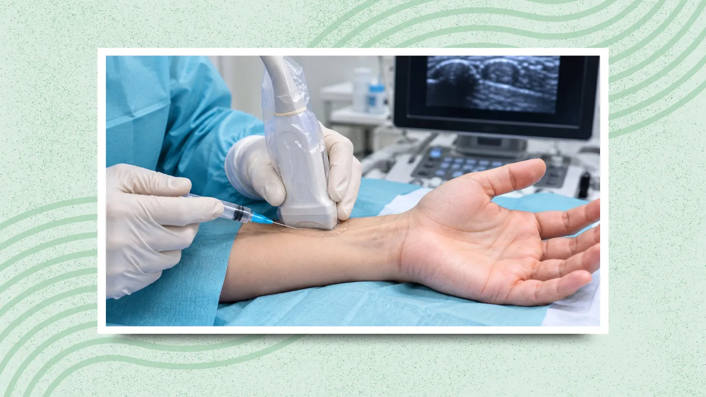 Minimally invasive procedure may ease carpal tunnel pain for months
