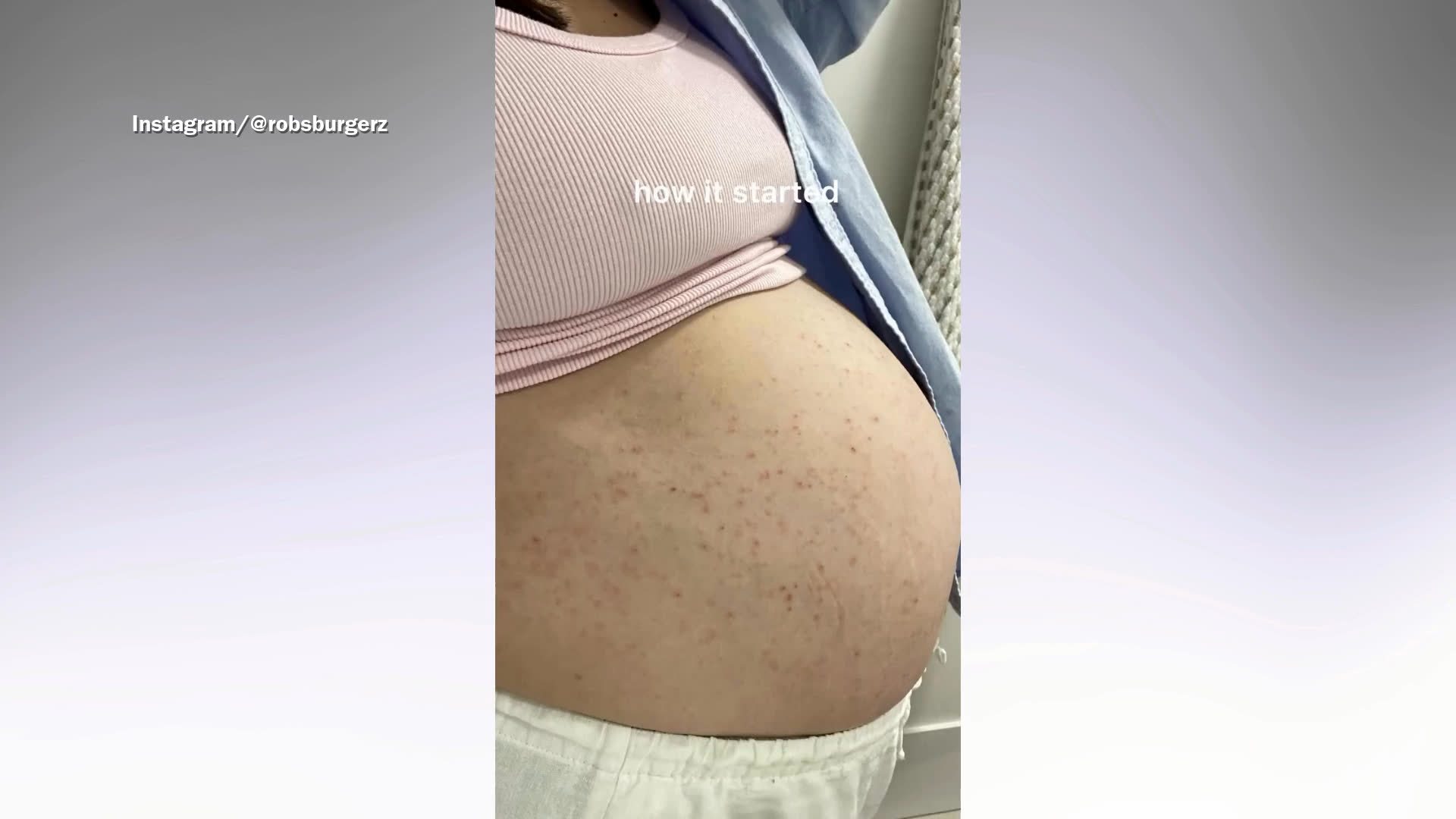 Pregnant woman gets biopsy for rash, never expected what it would reveal