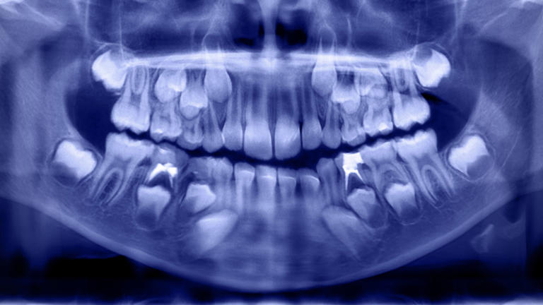 Higher levels of 19 potentially toxic chemicals found in the teeth of ...