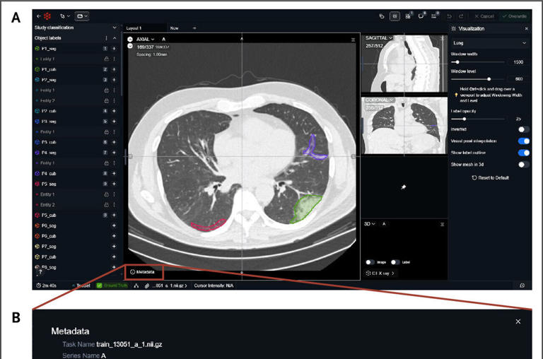 Public dataset aims to teach AI to 'show its work' on CT scans