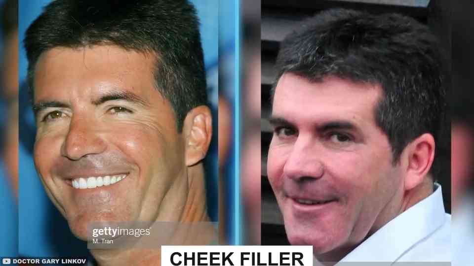 Simon Cowell went too far with fillers... then his own son gave him a ...